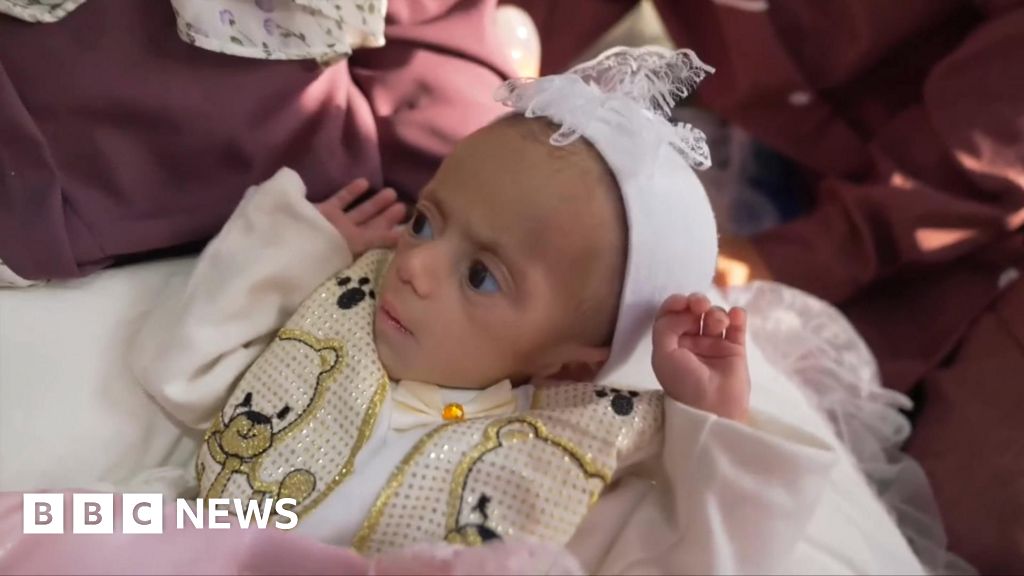 Malnourished baby Siwar evacuated from Gaza